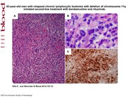 Herpes simplex virus lymphadenitis