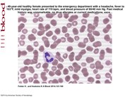 Borrelia hermsii relapsing fever