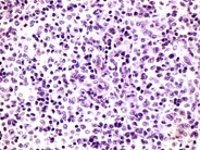 Herpes Zoster Lymphadenitis - 2.