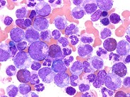 Chronic-Phase-CML--2