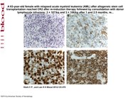 Graft-versus-leukemia in the bone marrow