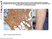 Darier’s sign in mastocytosis