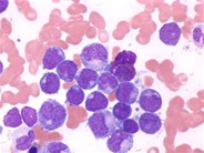 Acute myeloid leukemia with the t(8;21)(q22;22)