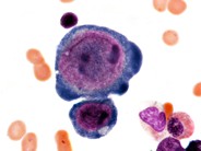 Parvovirus Inclusions - 3.