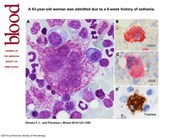 Giant multilobated mastocytes (promastocytes) in the setting of a refractory acute myeloid leukemia with myelodysplasia-related changes and monosomal