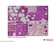 Progression of romiplostim myelofibrosis to myeloproliferative neoplasm