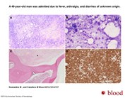 Bone marrow necrosis in de novo AML