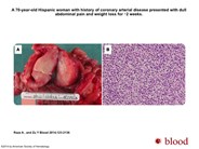 Enteropathy-associated T-cell lymphoma, type II (monomorphic variant)