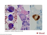 Cytomegalovirus-associated hemophagocytic lymphohistiocytosis in a patient with myasthenia gravis treated with azathioprine