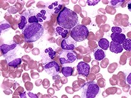 Dysmyelopoiesis - 1.