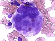 Essential-Thrombocythemia--4