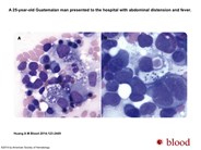 Hemophagocytic lymphohistiocytosis and disseminated histoplasmosis