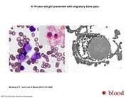 “Russell-like” bodies in Philadelphia chromosome–positive B-lymphoblastic leukemia