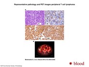 Peripheral T-cell lymphomas