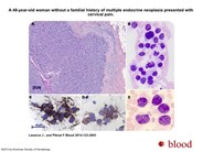 Aggressive bone marrow metastatic medullary thyroid carcinoma