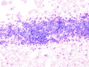 Undifferentiated Metastatic Neuroblastoma - 1.