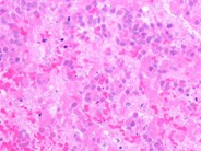 Undifferentiated Metastatic Neuroblastoma - 8.