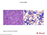 Atypical chronic myeloid leukemia