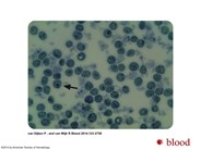 Revision of the diagnosis of a case of hereditary hemolytic anemia by supravital staining