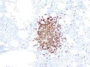 Rituximab-Associated Marrow T-cell Hyperplasia - 7.