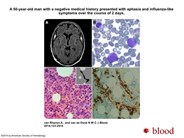 Rapidly progressive neurological deterioration without magnetic resonance imaging abnormalities: intravascular lymphoma