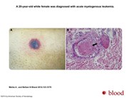 Disseminated fusariosis during acute myelogenous leukemia induction treatment
