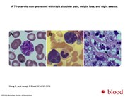 Diffuse large B-cell lymphoma in leukemic phase with flower cell morphology