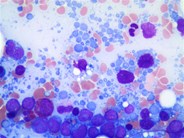 Bodies of evidence? Lymphoglandular bodies in aspirate smears of bone marrow involved by aggressive large B-cell lymphoma