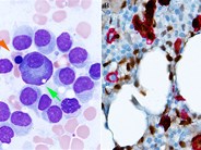 Chance identification of synchronous hairy cell leukemia and plasma cell myeloma in a potential HSC donor