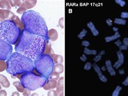 Acute myeloid leukemia pretreated with filgastrim mimicking acute promyelocytic leukemia