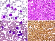 “Hairless” hairy cells