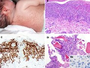 Langerhans cell histiocytosis with atypical histiocytic marrow infiltration