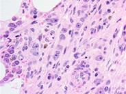 Neuroblastoma Ganglion Cell Differentiation Following Chemotherapy - 10.