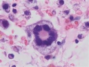 Blasts with rosette-like multinucleation in acute myeloid leukemia with complex cytogenetic abnormalities
