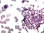 A rare cause of lower back pain