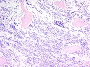 Neuroblastoma Ganglion Cell Differentiation Following Chemotherapy - 2.