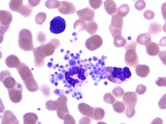 Platelet satellitism due to EDTA Anticoagulant - 4.