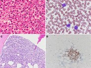 Spontaneous splenic rupture in mantle cell lymphoma with leukemic variant