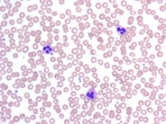 Platelet satellitism due to EDTA Anticoagulant - 7.