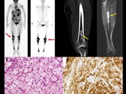 Erdheim-Chester disease