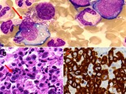 Hemophagocytosis due to bone marrow ALCL, ALK–