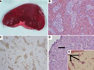 Hepatosplenic T-cell lymphoma