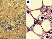 EBV-driven HIV-associated diffuse large B-cell lymphoma causing profound lactic acidosis