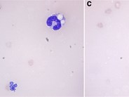 Massive hemolysis and erythrophagocytosis in severe sepsis