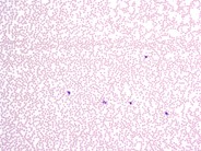 Kostmann's Syndrome - 1.