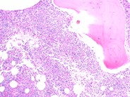 Kostmann's Syndrome - 7.