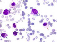Auer rods in dysplastic granulocyte
