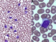 Abnormal lymphocytes with “filamentous-like” cytoplasmic inclusions in chronic lymphocytic leukemia