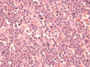 Anaplastic Large Cell Lymphoma - 1.