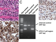 Extensive and destructive invasion of adult T-cell leukemia/lymphoma cells into systemic muscular tissues